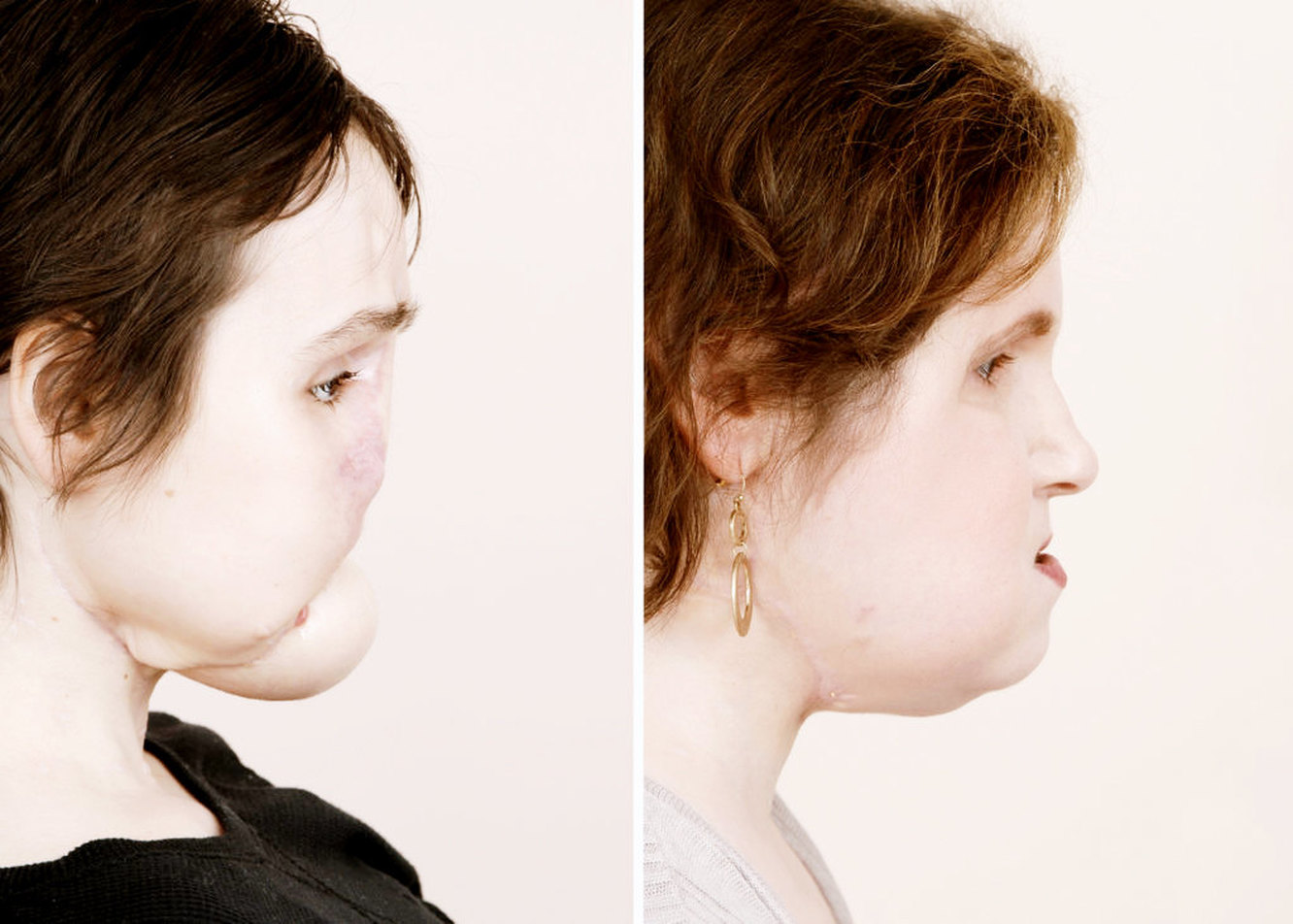 Пересадка волос до и после, противопоказания и реабилитация