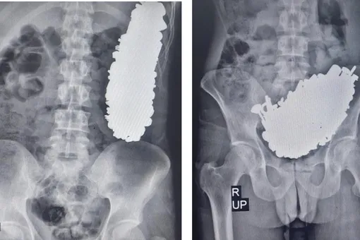 В Иране врачи извлекли из желудка пациента 452 металлических предмета